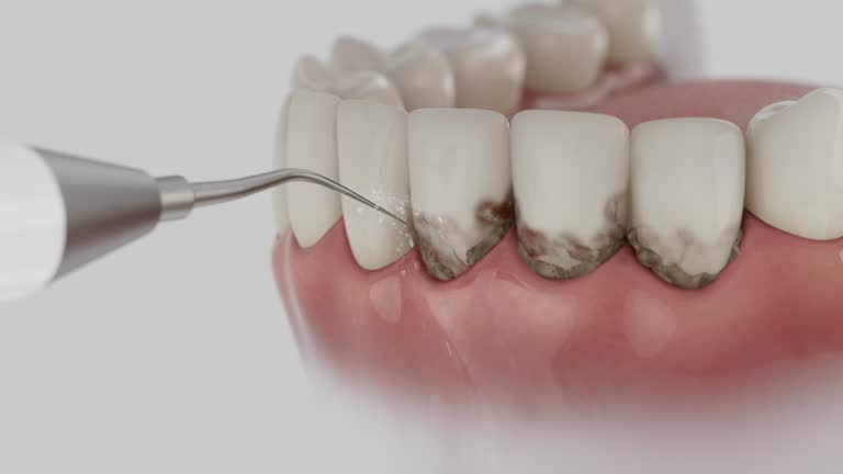 Trusted Wisdom Tooth Removal service in Gallitzin, PA - Dentist Open Now